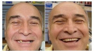Имплантация зубов
